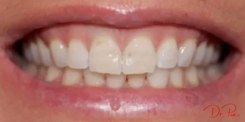 How to Close a Gap Between Your Front Teeth: Your Options