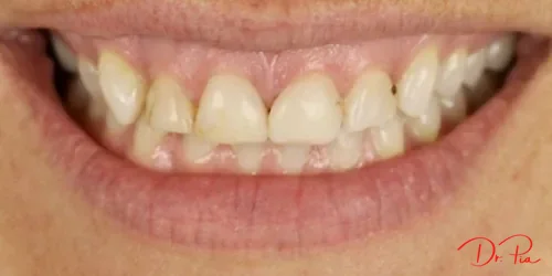 Teeth Whitening: What Actually Works (and What's a Waste of Money)