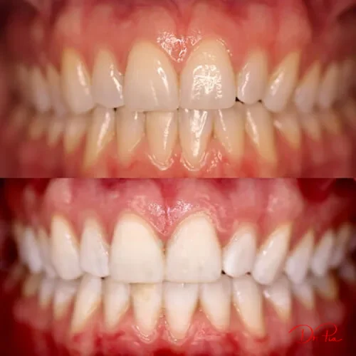 See Your New Smile First: How Digital Smile Design Works