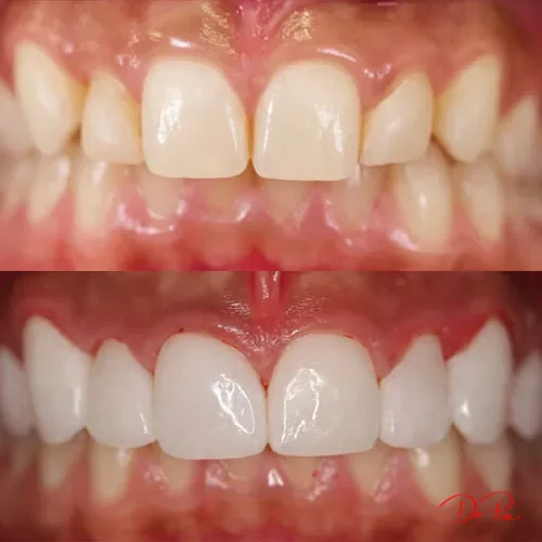 Can AI Detect Cavities Better Than Your Dentist?
