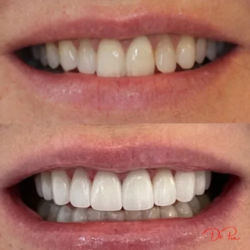 Tooth Extraction Aftercare: How to Heal Faster and Avoid Problems