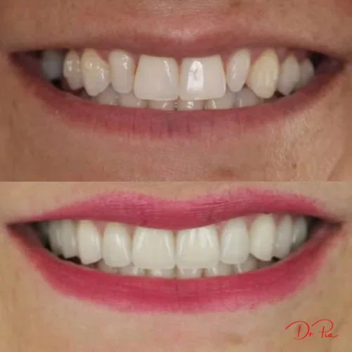 Dental Bridges vs. Implants: Which Is Right for a Missing Tooth?