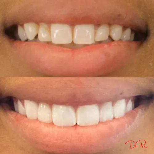 How Much Do Braces Really Cost? A Breakdown by Type