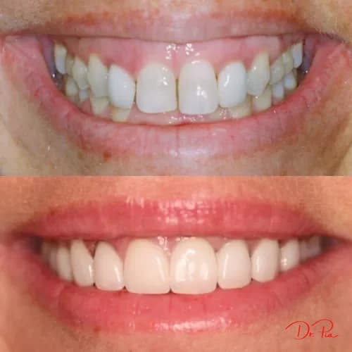 Braces vs. Invisalign: Which One Is Right for You?