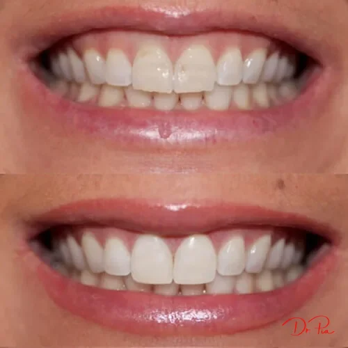 Why Are My Teeth Suddenly Sensitive? Causes and Fixes