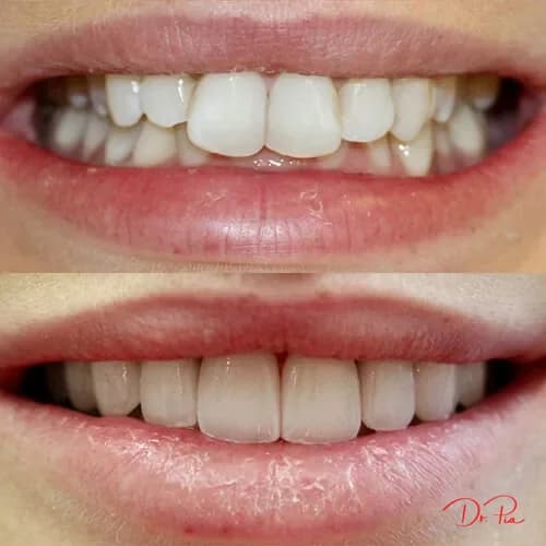 Why Do My Gums Bleed When I Brush? It's Not Normal
