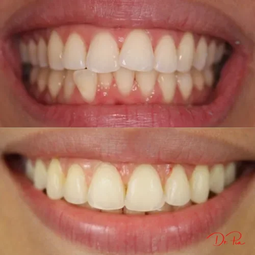 How Cavities Form (and How to Stop Them Before They Start)