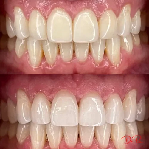 Does Charcoal Toothpaste Really Whiten Teeth? The Truth