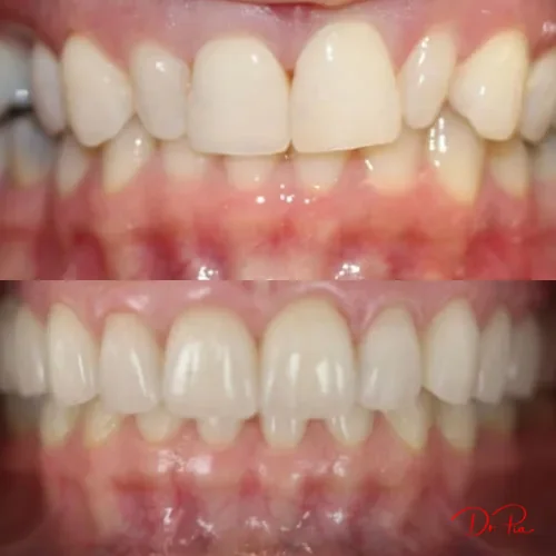 Dental Implants 101: Cost, Process, and Whether They're Worth It