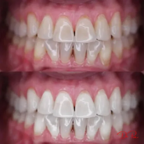 One Tooth Darker Than the Rest? Here's Why and How to Fix It