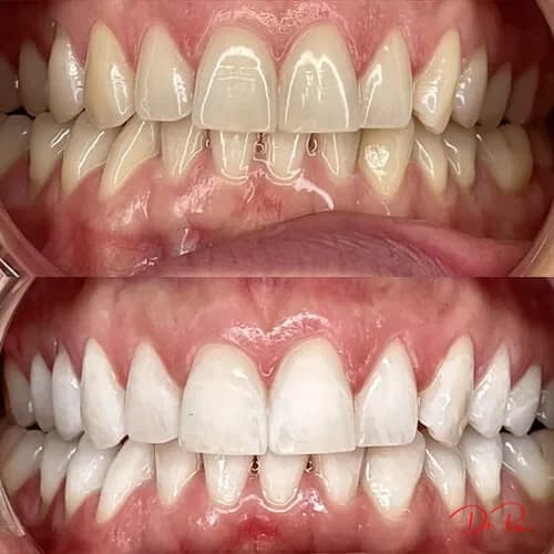 Is Cosmetic Dentistry Permanent? What's Reversible and What Isn't