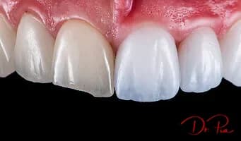 Snap-On / Removable Veneers: Do They Actually Work?