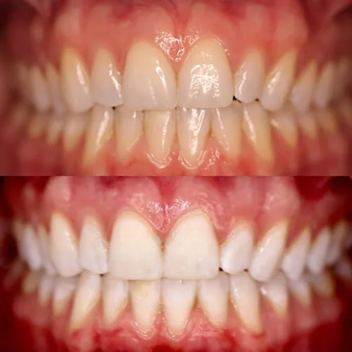 Before-and-after smile transformation by Dr. Pia Lieb, gallery image 2