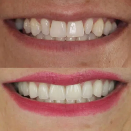 Before-and-after smile transformation by Dr. Pia Lieb, gallery image 6