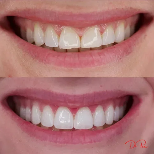 Does Oil Pulling Whiten Teeth? What the Evidence Shows