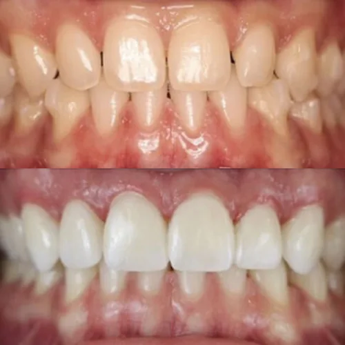 Before-and-after smile transformation by Dr. Pia Lieb, gallery image 5