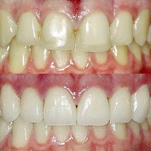 Before-and-after smile transformation by Dr. Pia Lieb, gallery image 4