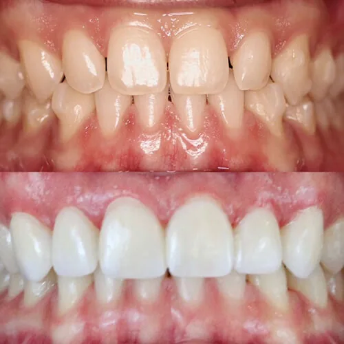 Before-and-after smile transformation by Dr. Pia Lieb, gallery image 3