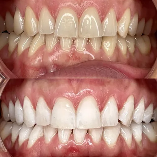 Before-and-after smile transformation by Dr. Pia Lieb, gallery image 1