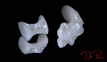 Inlays and Onlays: Between a Filling and a Crown